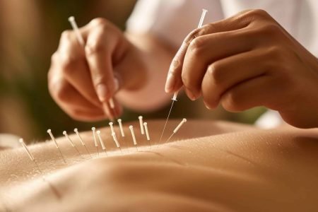 Acupuntura
